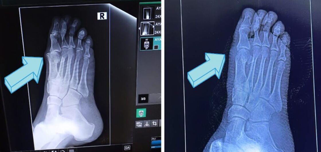 Two images of x-rays for Brent's right foot. The first is before the surgery and shows the bone spurs. The second is post-surgery and shows them removed.
