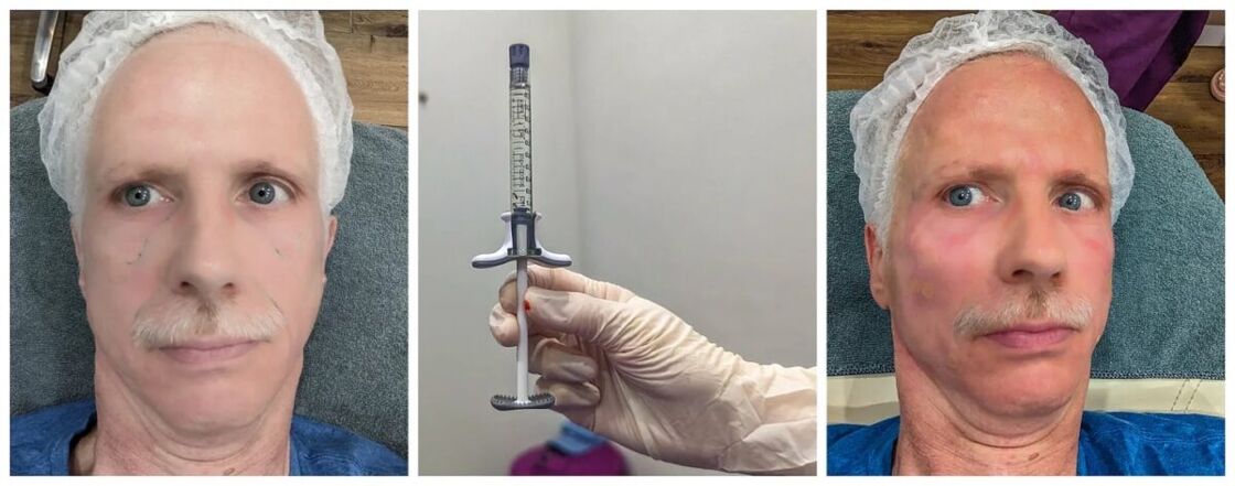 Michael Jensen before surgery, a syringe, and shortly after surgery