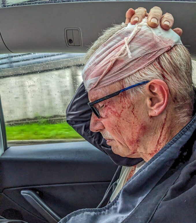 Michael in Uber, eyes closed, hand clutching his bloody bandaged head. Michael in Uber, eyes closed, hand clutching his bloody bandaged head.